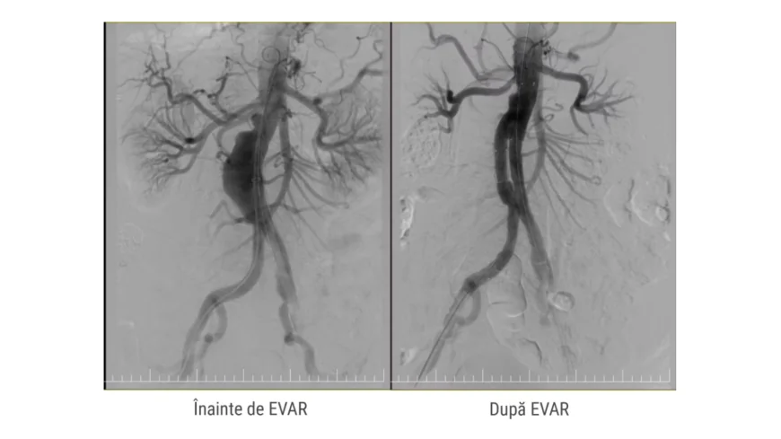 Anevrismul de aortă toraco-abdominal: Simptomele apar când afecțiunea este deja gravă. Cum se tratează microinvaziv și chirurgical la MONZA ARES