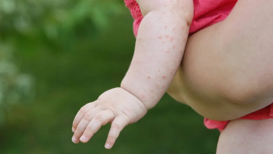 SUA se confruntă cu cea mai gravă epidemie de rujeolă din secolul XXI. Secretarul de stat Robert Kennedy Jr., acuzat că o alimentează